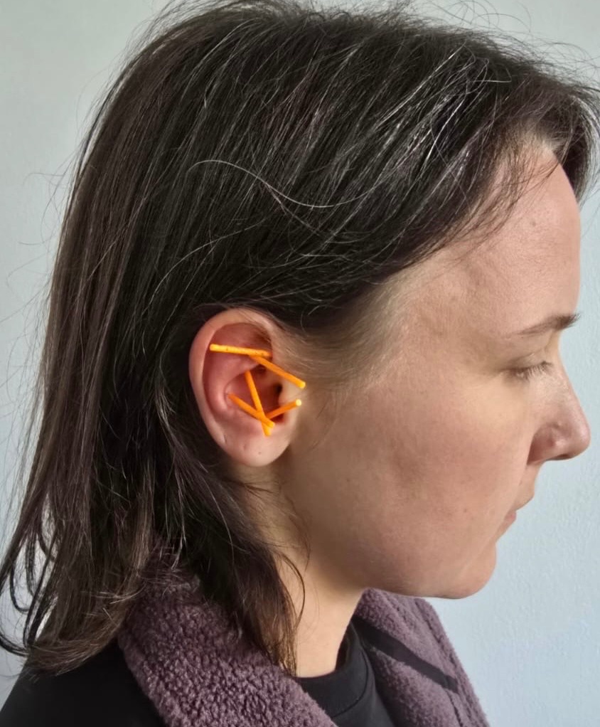 NADA ear acupuncture — auricular needles at Vireya Wellness, Marylebone